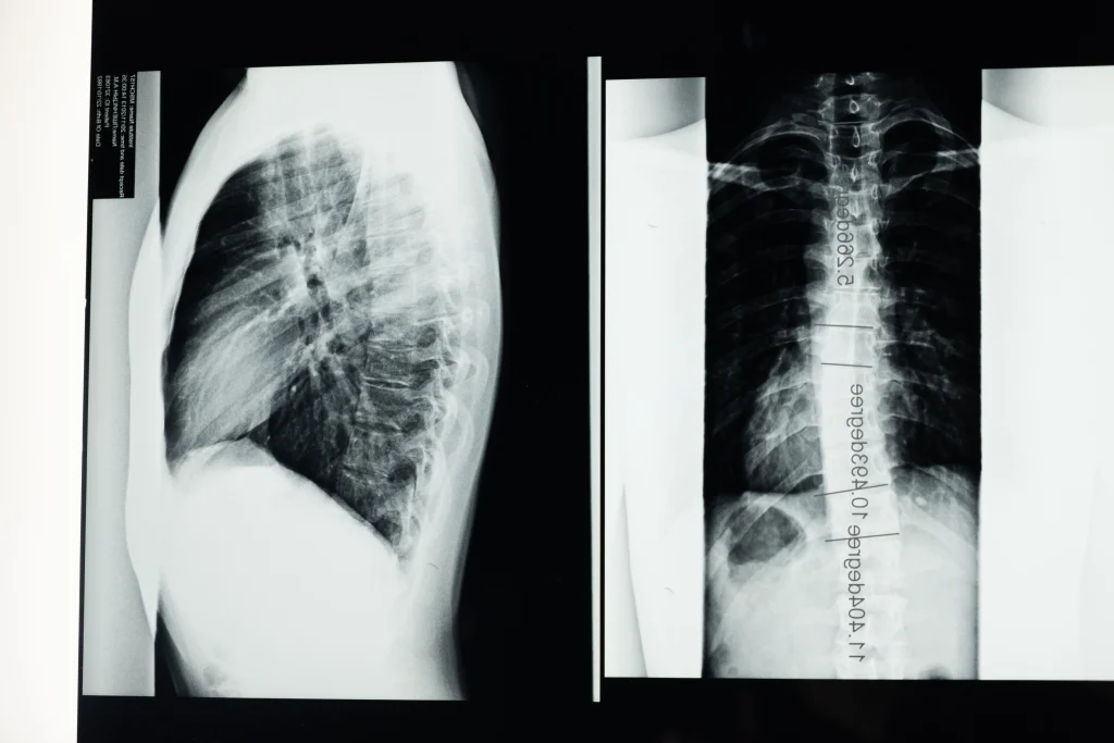 Xray pf a catastrophic injury of the back. This person should contact a personal injury lawyer.